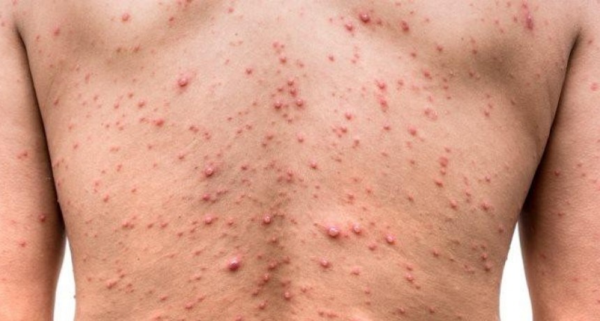 España detectó 59 casos de viruela del mono y comprará vacunas