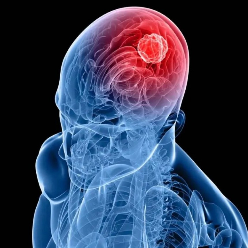 Investigación de CONICET logra frenar un tipo de cáncer cerebral