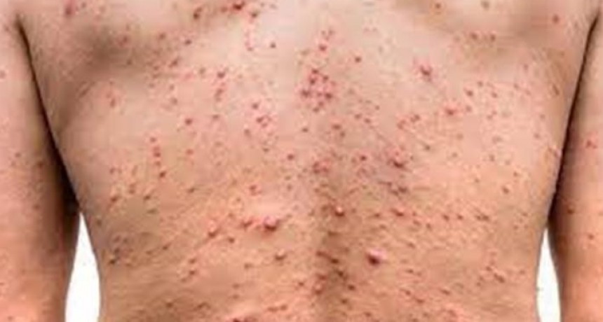 Confirmaron en el país 326 casos de viruela símica