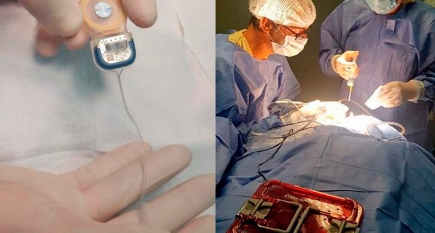  San Luis: un nuevo modelo de implante permitirá a dos personas volver a escuchar